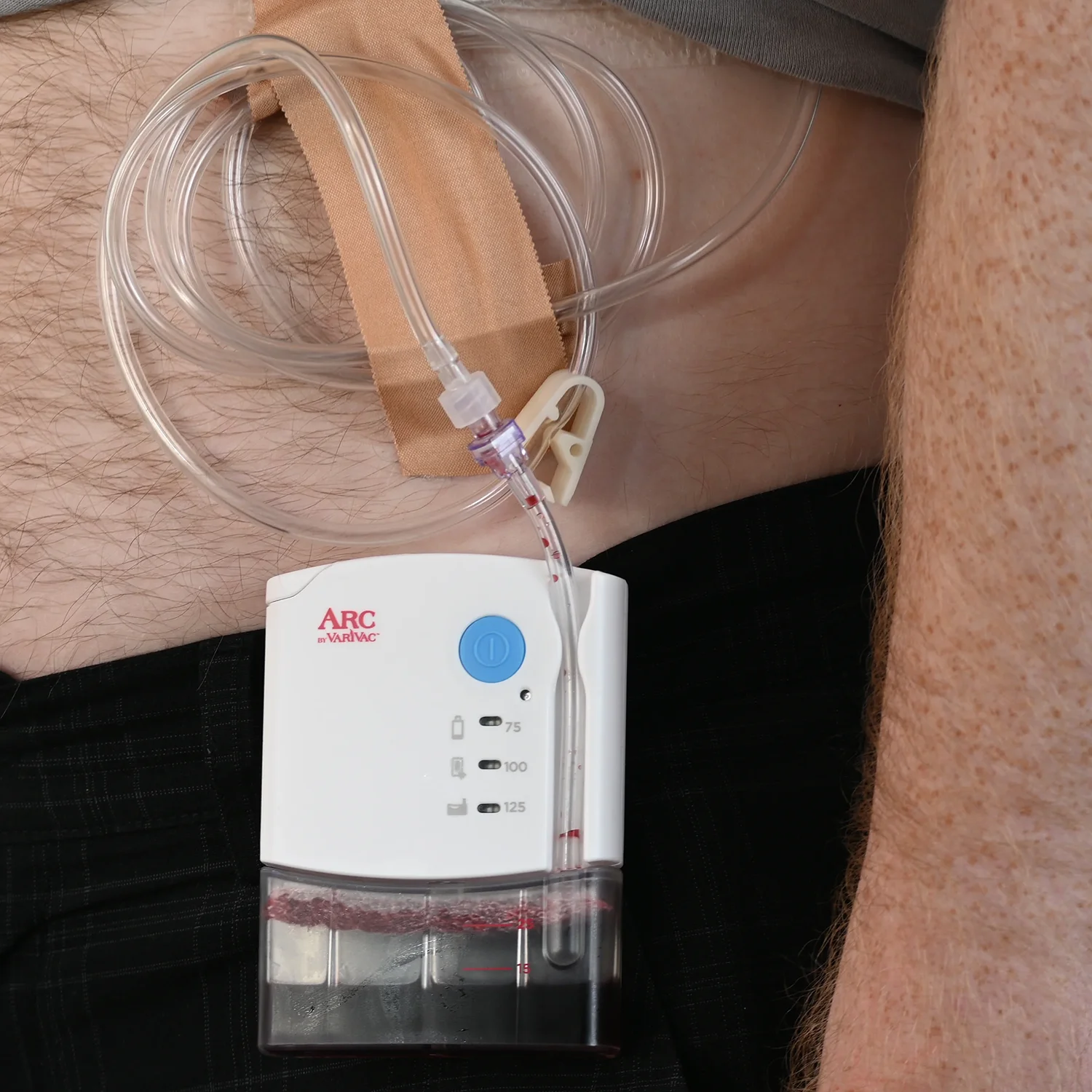 Varivac, Medical, Vacuum suction pump for wound drainage. This image displays the development of the arc varivac device. The device here is in use on a patient